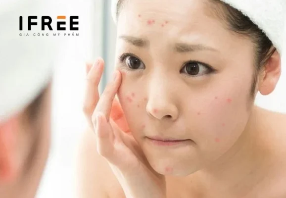 Da mụn dùng kem chống nắng